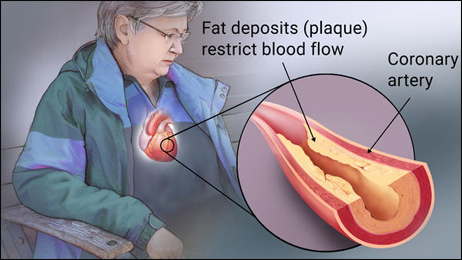 Ischemic Heart Disease