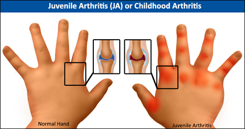 Childhood Arthritis, Juvenile Arthritis