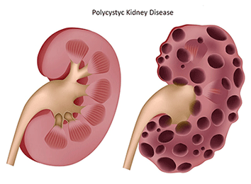 reduce urea and creatinine levels, Ayurvedic Medicines