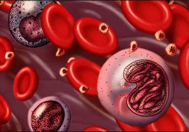 Chronic Myelomonocytic Leukemia Chronic Myelomonocytic Leukemia