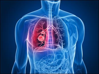 Malignant Mesothelioma Malignant Mesothelioma