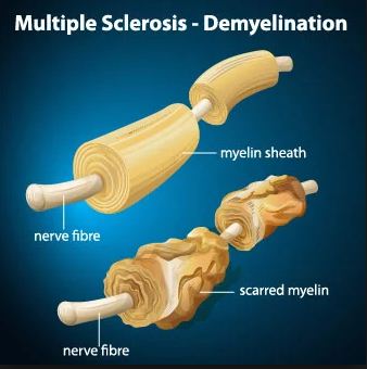 Multiple Sclerosis