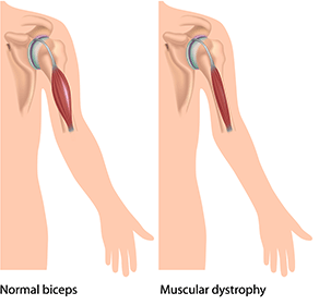 Muscular Dystrophy