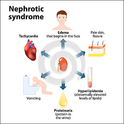 Nephrotic syndrome