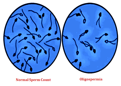 Oligospermia