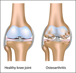 Osteoarthritis