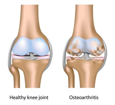 Osteoarthritis Osteoarthritis