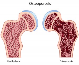 Osteoporosis Osteoporosis