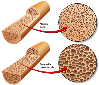 Low Bone Density, Osteoporosis