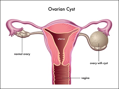 Ovarian Cyst Size Chart