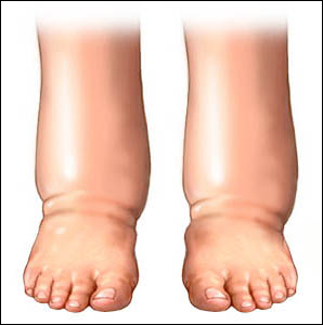 Pedal edema