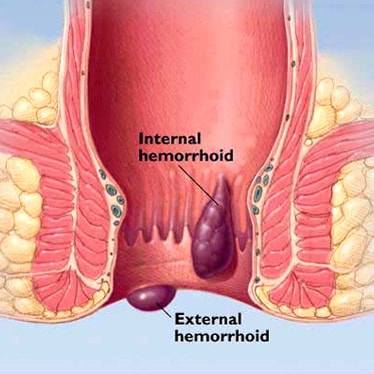 Hemorrhoids (Piles)