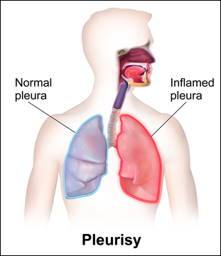 Pleurisy