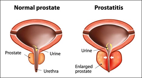 Mint Pepper Prostatitis)