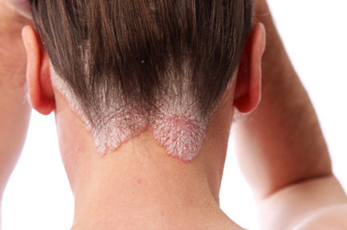 Psoriasis Psoriasis
