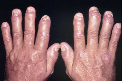 Psoriatic Arthritis Psoriatic Arthritis Hand