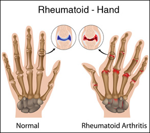 Rheumatoid arthritis