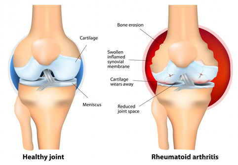 stubborn grass Remedy for joint pains, Rheumatism, arthritis.