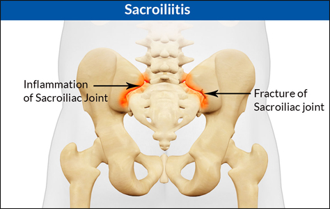 Bilateral Sacroiliitis