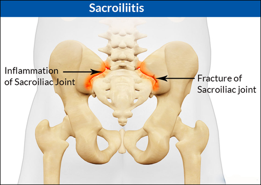 Sacroiliitis