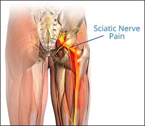 https://www.planetayurveda.com/pa-wp-images/sciatic-nerve-pain.jpg