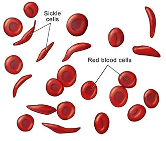 Sickle Cell Anemia