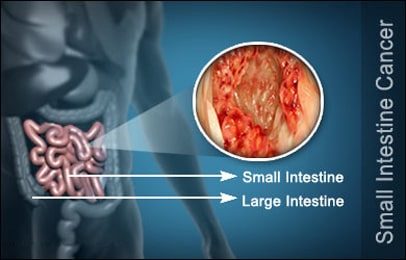 How To Treat Small Intestine Cancer In Ayurveda Planet Ayurveda