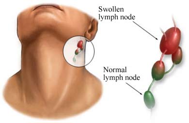 amoxicillin for swollen lymph nodes