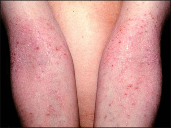 Atopic dermatitis