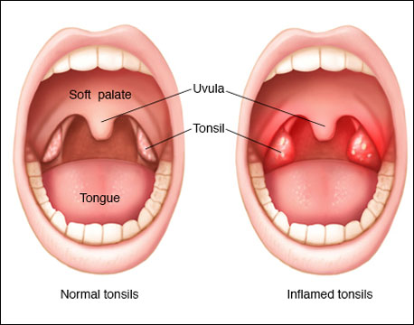 Tonsillitis