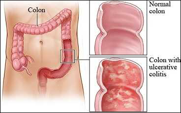 treatment of uc