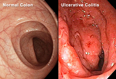 Ulcerative Colitis