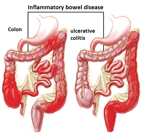 Ulcerative Colitis Ulcerative Colitis
