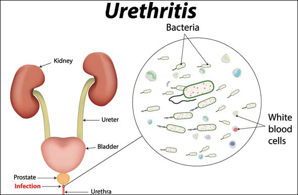 Urethritis