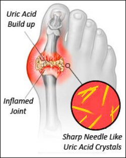 Gout, Uric acid