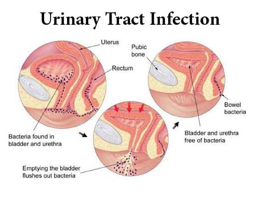 Diet Chart For Urine Infection