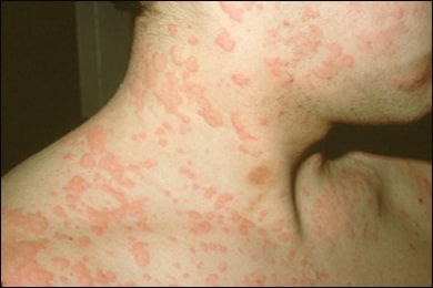 Urticaria, Hives