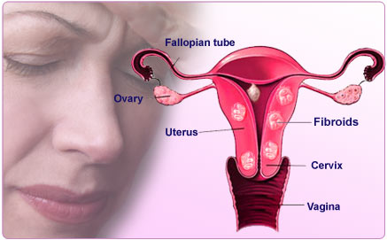 Uterine Fibroids
