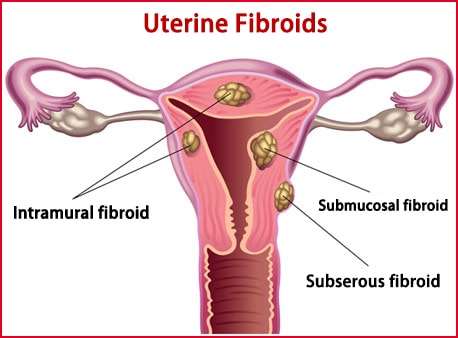 Intramural Fibroid Size Chart