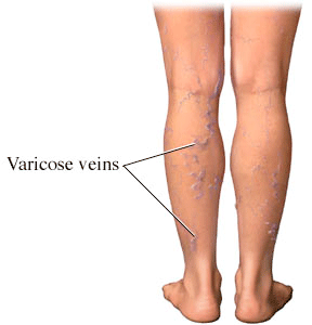 varicoza de boala vasculara de la vene varicoase putei muri