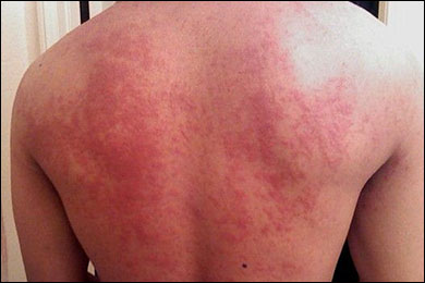 Idiopathic Thrombocytopenic Purpura