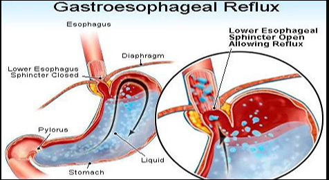 Natural Treatment of Gastroesophageal Reflux Disease