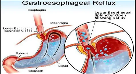 Gastroesophageal reflux disease Gastroesophageal reflux disease