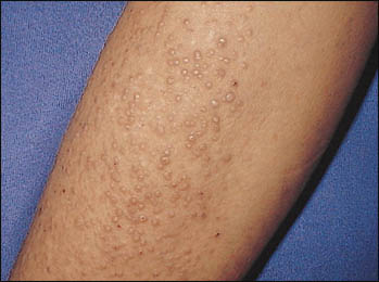 Lichen amyloidosis