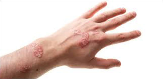 Psoriatic Arthritis
