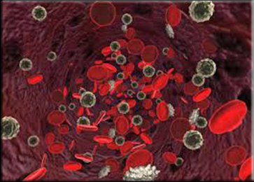 Evans Syndrome