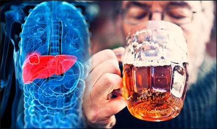 Alcoholic Liver Diseases Alcoholic Liver Diseases