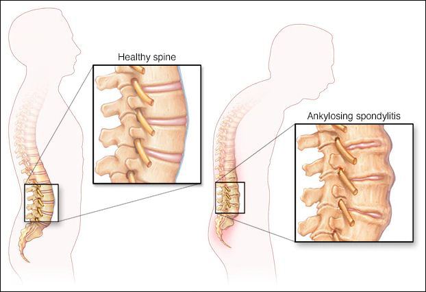 Food Diet Chart For Ankylosing Spondylitis