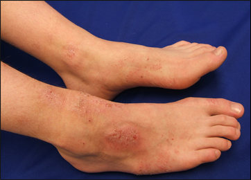 Atopic Dermatitis