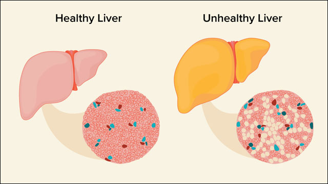 Fatty Liver Fatty Liver
